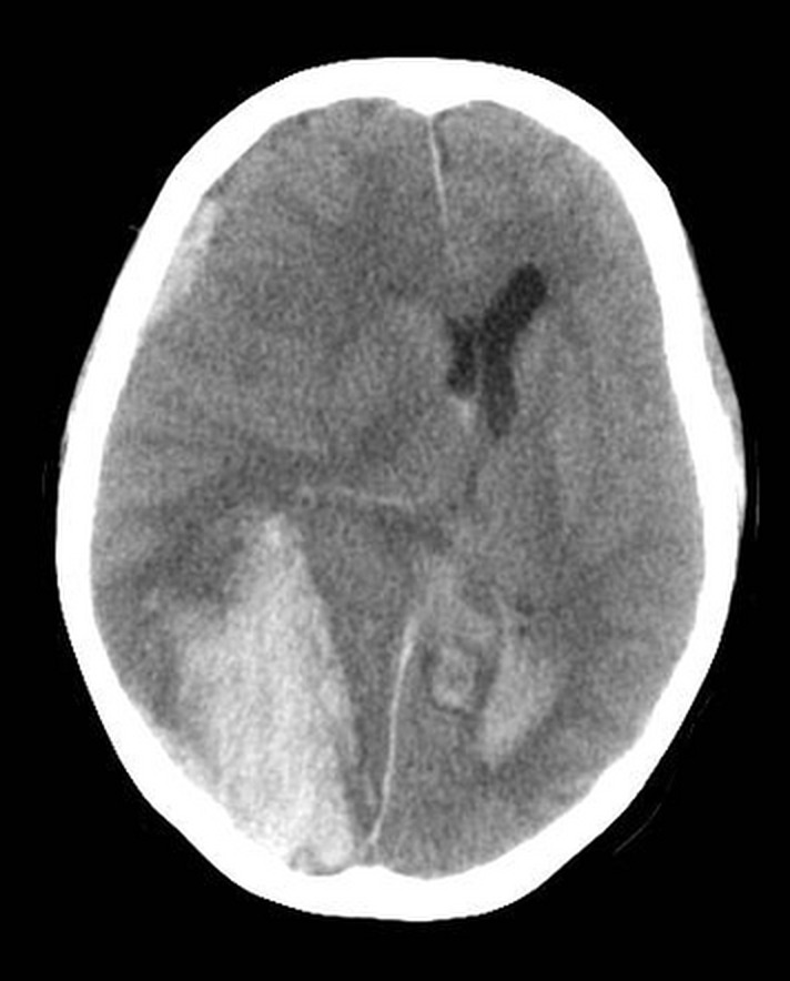 AVC Hemoragic (CT nativ)