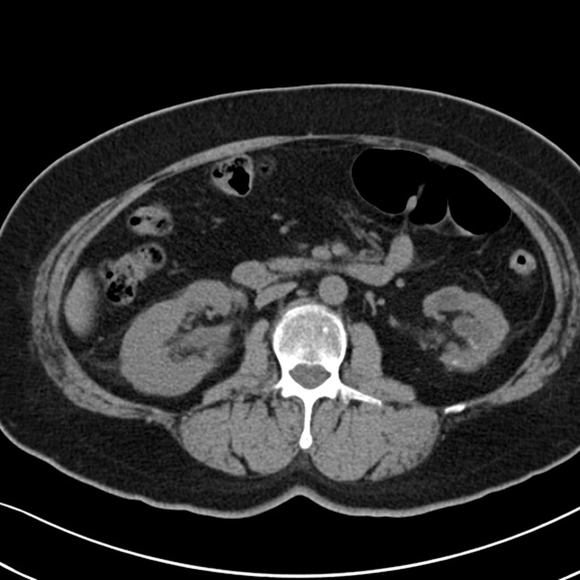 CT renal — Hidronefroză dreaptă