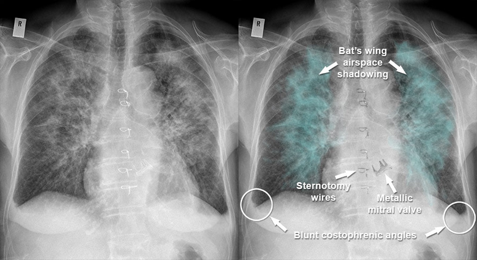 Edem alveolar (aripi de fluture)