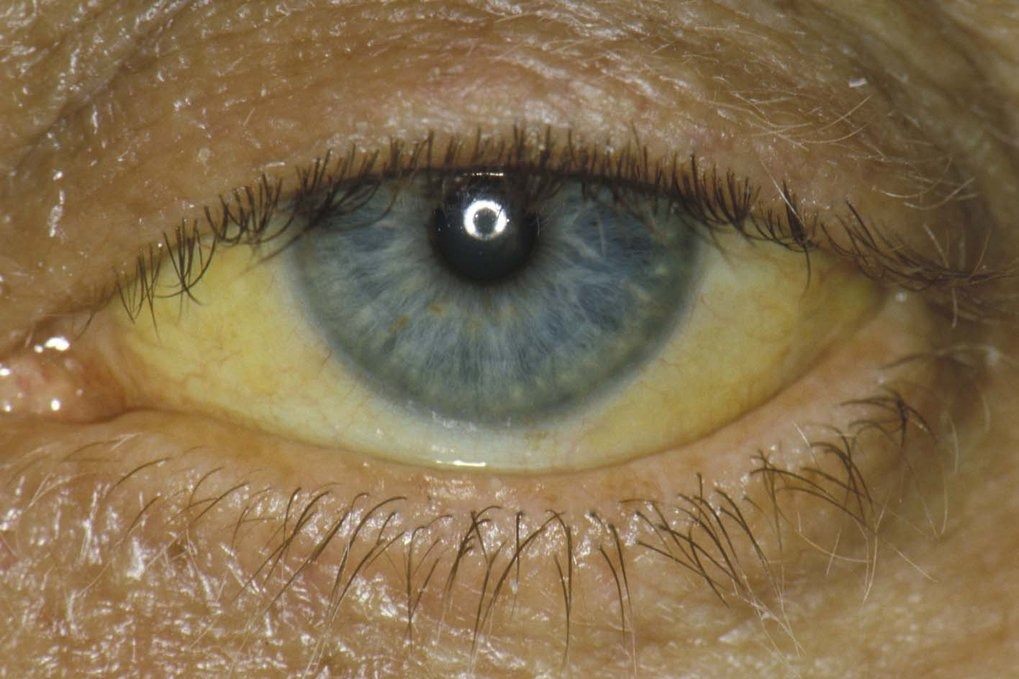 Icter scleral