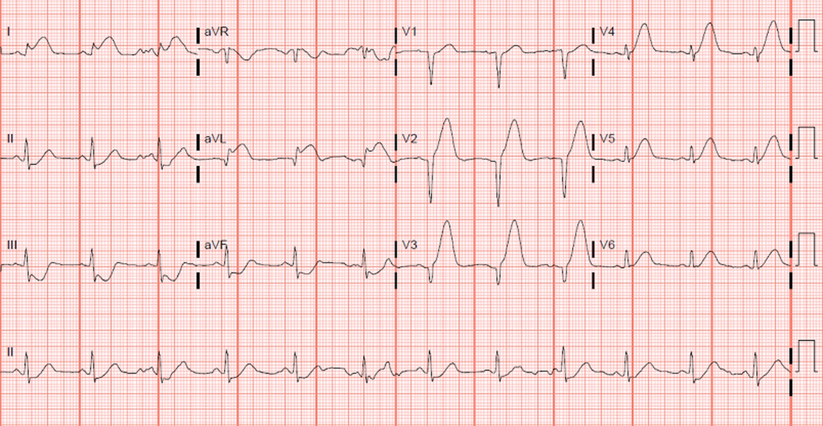STEMI (Supradenivelare ST)