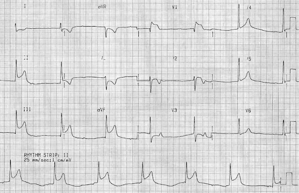 Infarct miocardic inferior