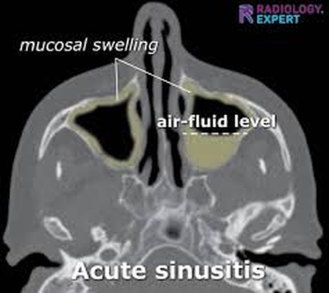 Aspect CT în sinuzita acută
