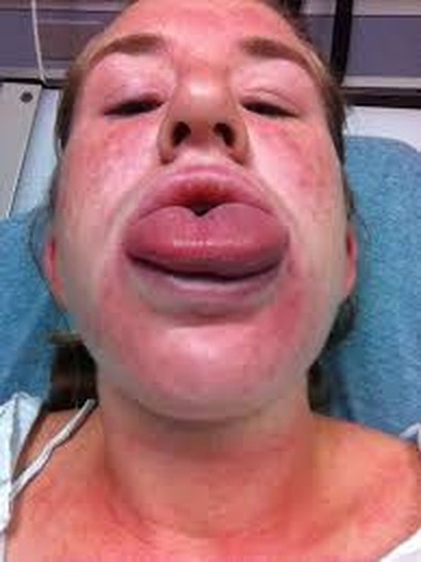 Angioedem facial