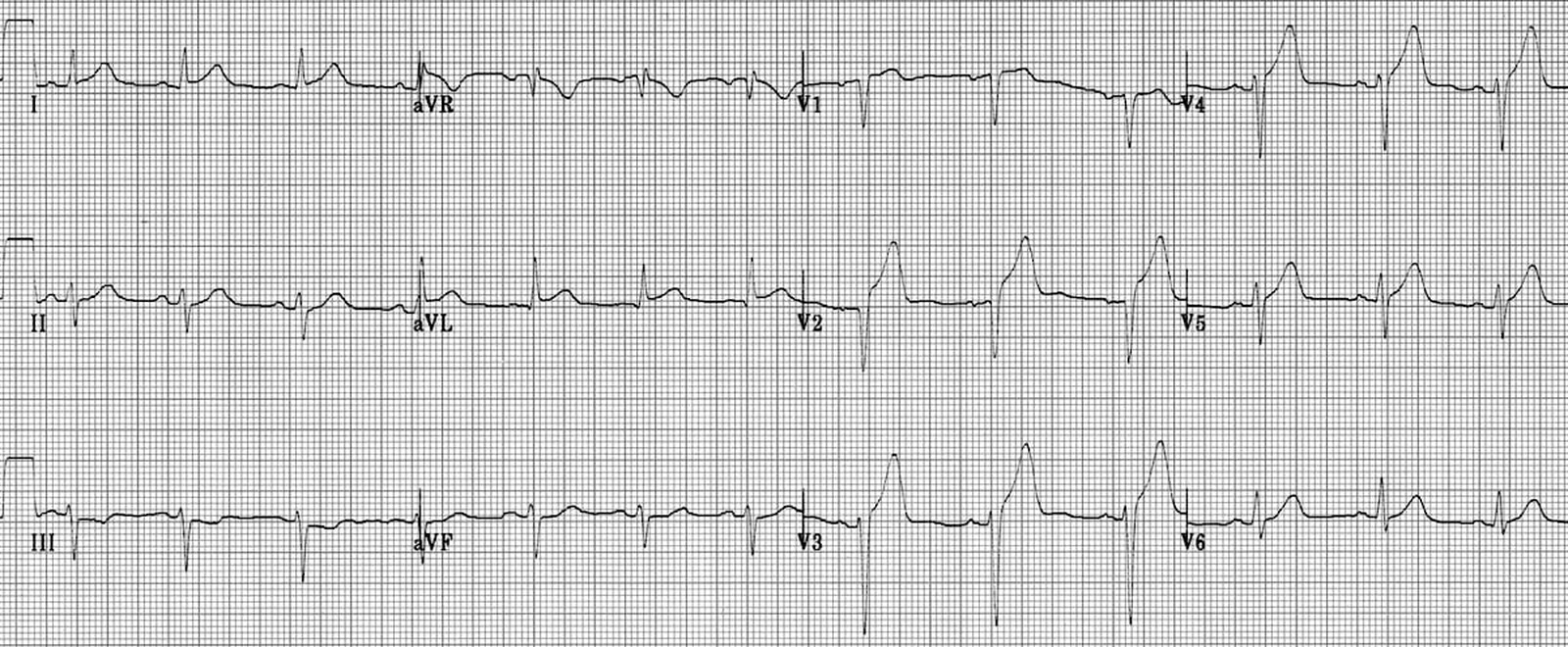 Modificări ECG în STEMI
