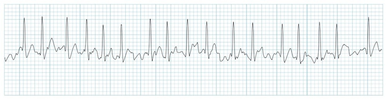 Traseu EKG în fibrilația atrială