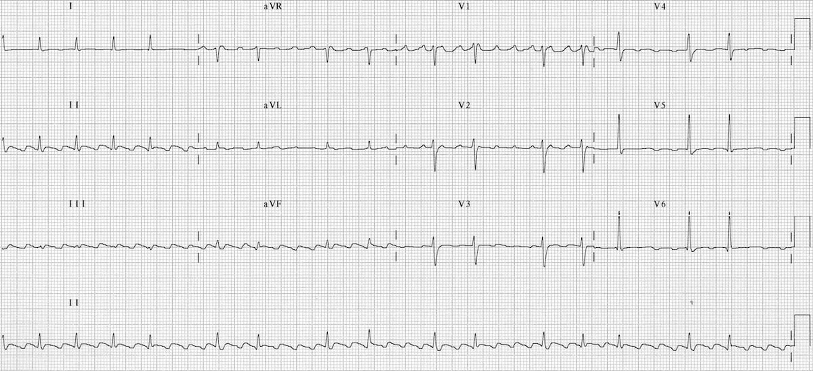 Traseu EKG în flutterul atrial cu bloc variabil
