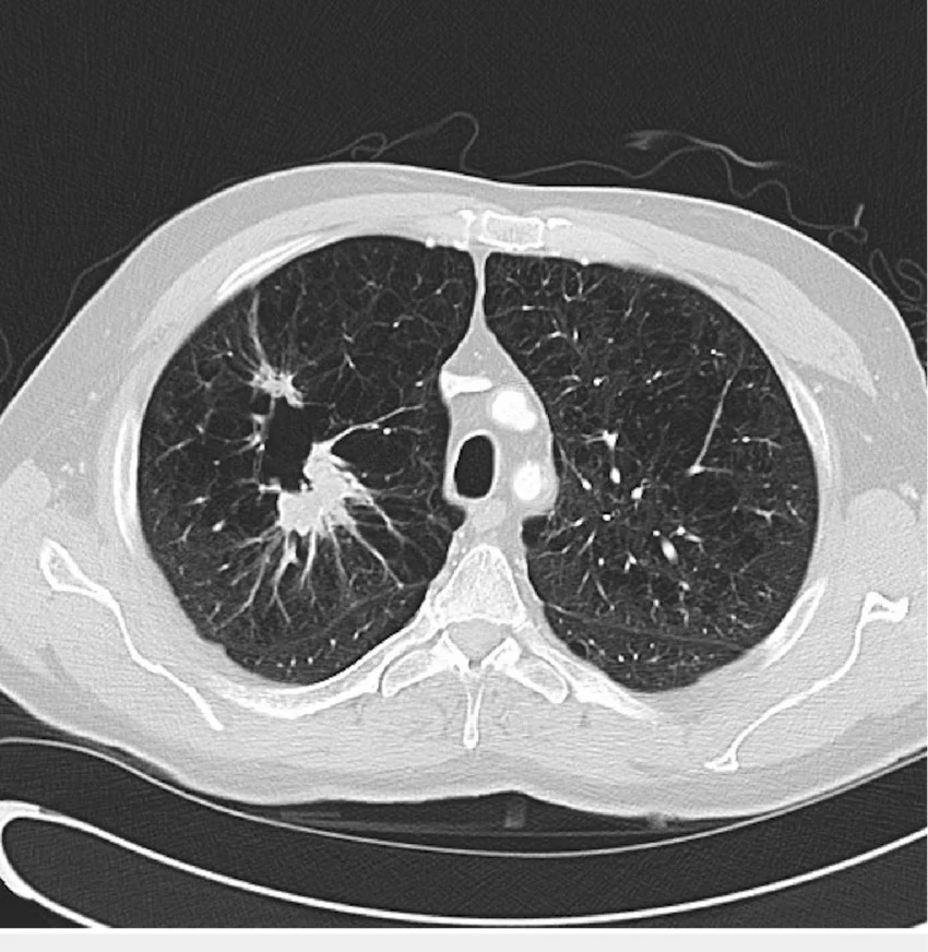 Aspect CT neoplasm pulmonar