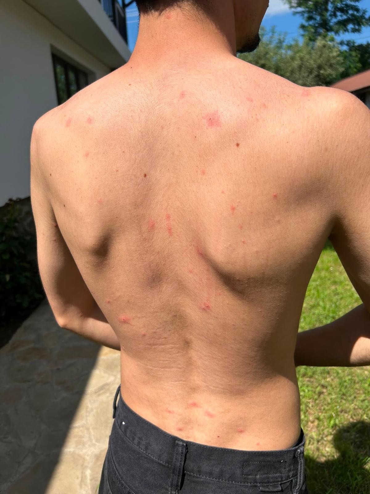 Varicelă atenuată la adult tânăr vaccinat