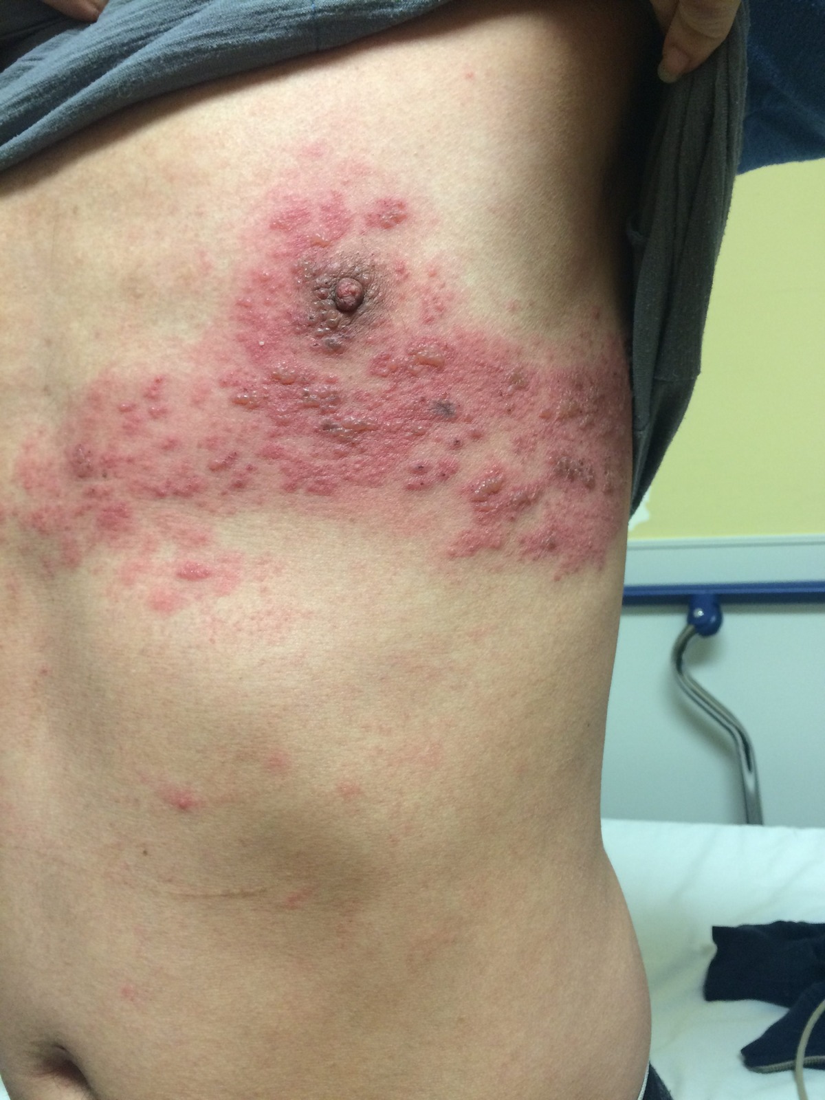 Reactivarea virusului varicelo-zosterian — Herpes Zoster (Zona Zoster)